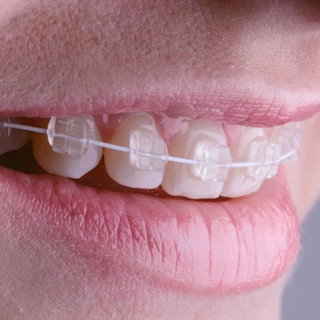 An up-close view of a person’s mouth and the LightForce 3D Printed Ceramic Braces that exist on the top row of teeth