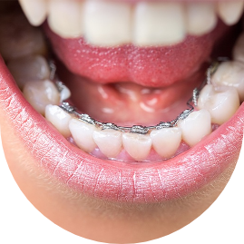 Close up of a smile with braces on the backs of the teeth