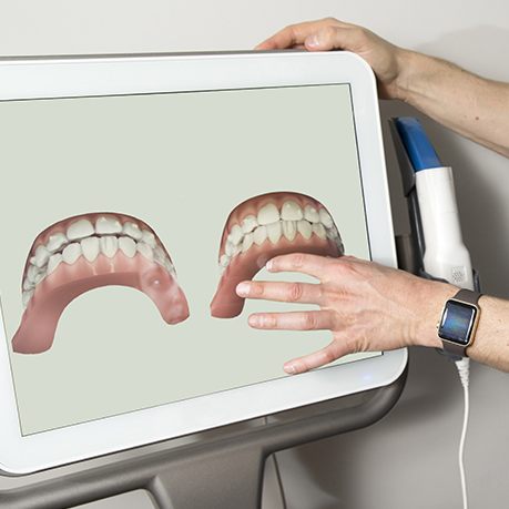 iTero scans of smile before Invisalign treatment