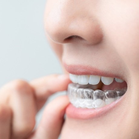 : Closeup of patient placing clear aligner on bottom teeth