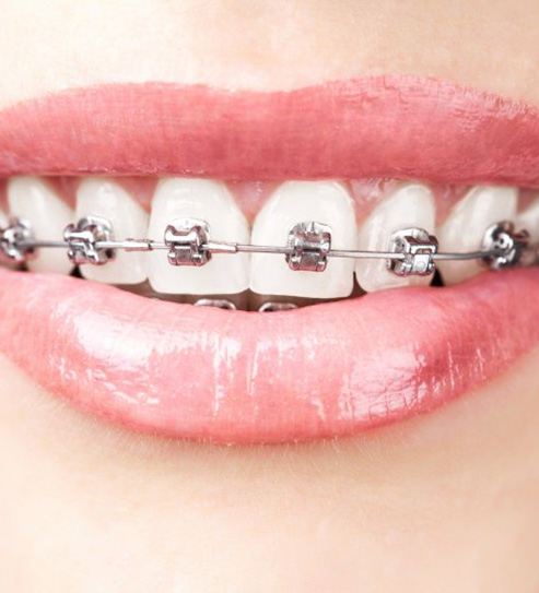 Smile with self-ligating braces