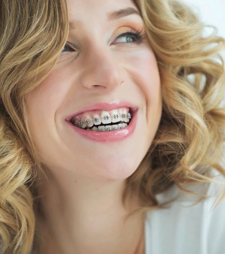 Lady smiles with braces