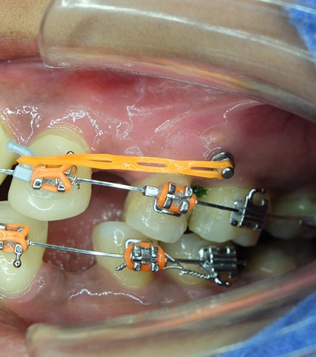 Photo of TAD attached to braces