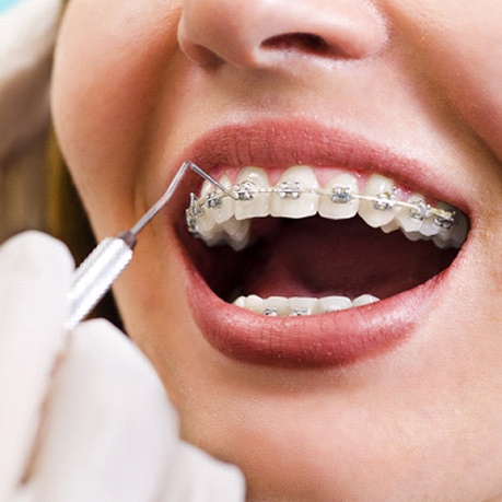 An up-close image of an orthodontist performing work on a patient’s metal braces