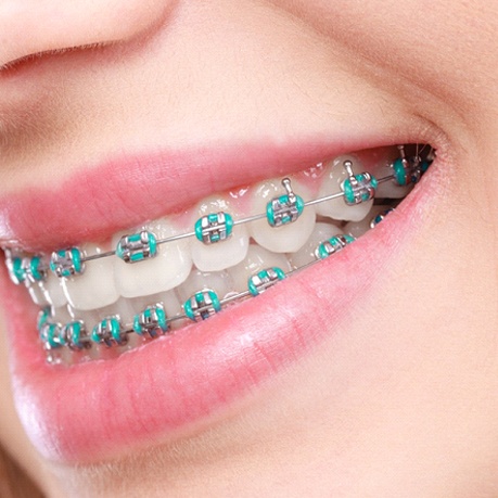 An up-close look at a person’s smile, complete with metal braces and colorful ligatures