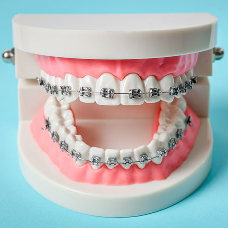 A tooth model displaying metal braces