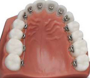 top-alternatives-to-braces