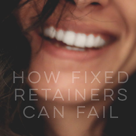 How Fixed Retainers Can Fail