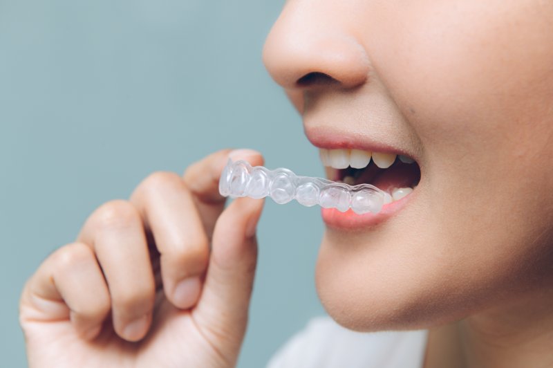 Invisalign® Treatment St. John's