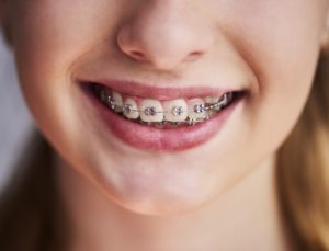 Closeup of smile with braces for children