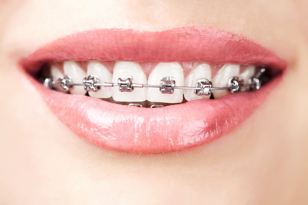 close-up of smile with metal braces