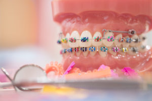 a model of a mouth with braces and colorful brackets on it