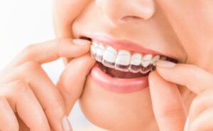 Woman placing Invisalign aligner on her top teeth