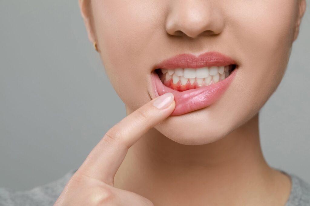Nose-to-neck view of woman pulling down lower lip to reveal swollen gums