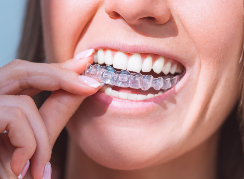 Woman putting in retainer