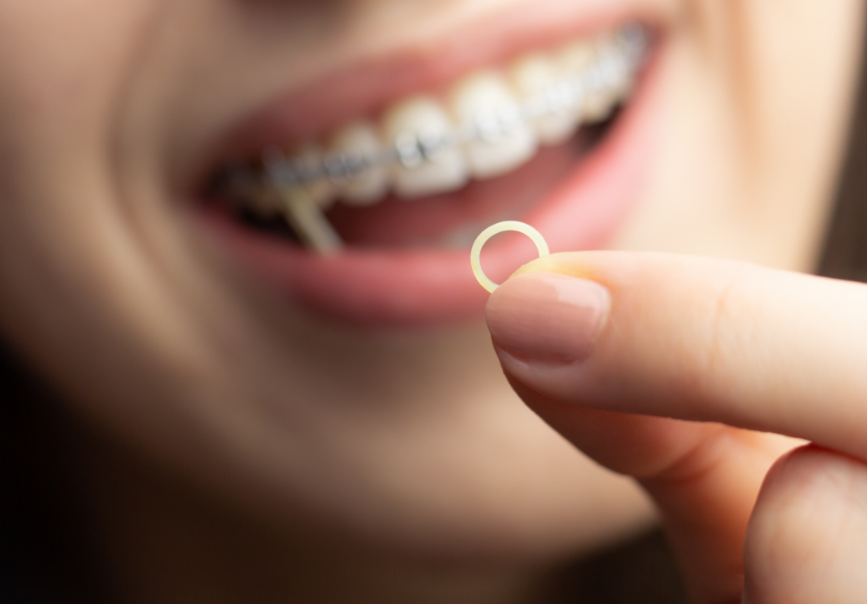 Close up of girl's smile with braces, holding rubber band