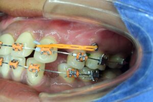 Temporary anchorage device being used with braces 