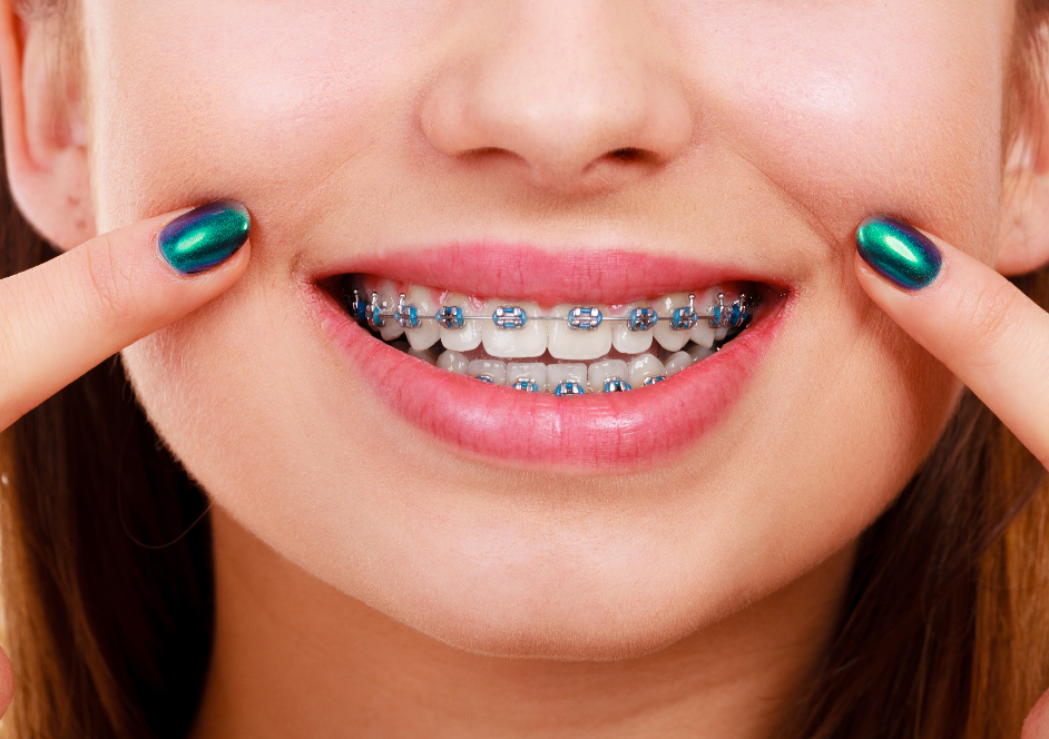 Close up of woman's smile with braces. Her fingertips are pointed at her smile and she has metallic green nail polish on.