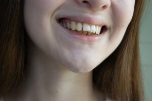 Woman smiling with an overbite